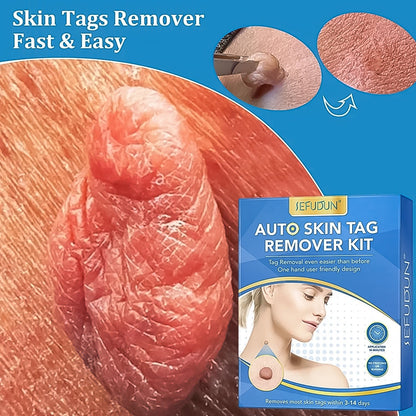 Close-up of a large skin tag with a small blue box for the skin tag remover kit.